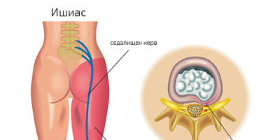 Лечение на ишиас чрез неинвазивни методи